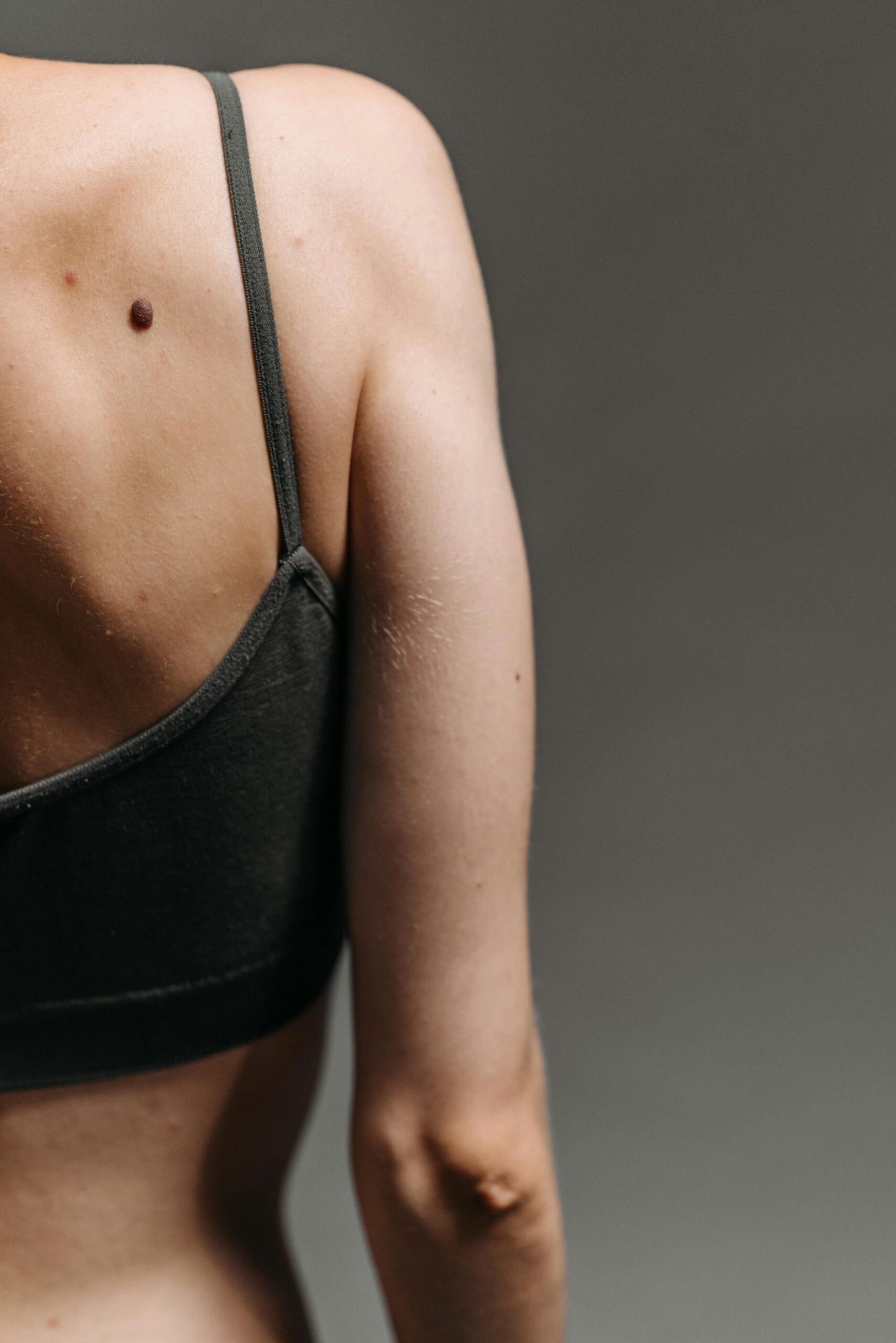 Entfernung von gutartigen Hautveränderungen in Chur