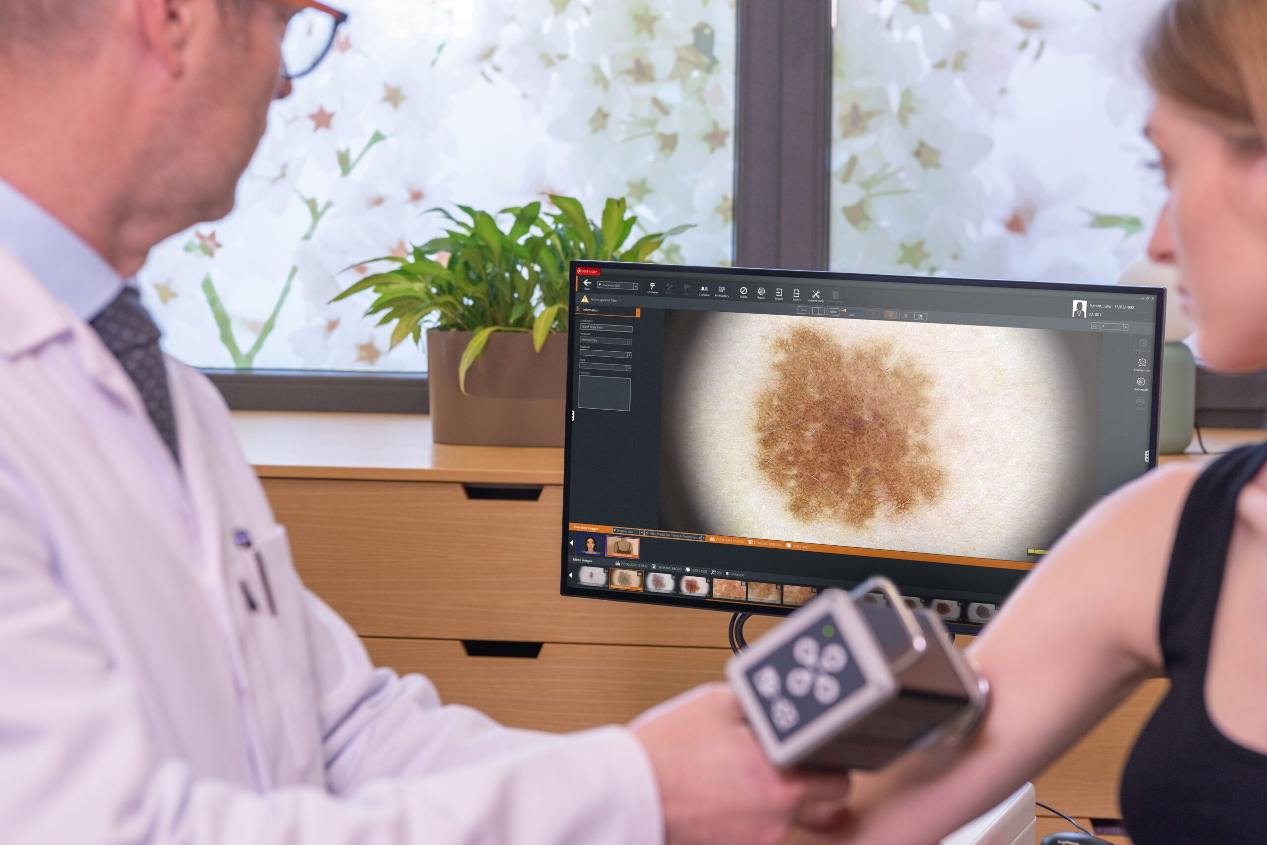 Hautkrebs Vexia FotoFinder